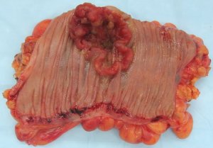 Cancer de colon